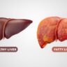 The image showing the difference between a healthy liver and a fatty liver